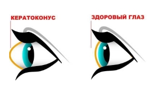 Убираем кератоконус. Возвращаем нормальную форму глаз | Людмила Лазарева