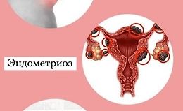 Школа здоровья. Эндометриоз logo