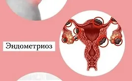 Школа здоровья. Эндометриоз