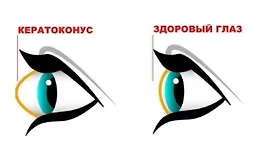 Убираем кератоконус. Возвращаем нормальную форму глаз