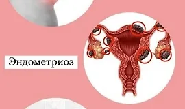 Школа здоровья. Эндометриоз