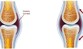 Здоровье суставов ног от А до Я
