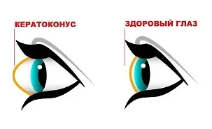 Изображение курса Убираем кератоконус. Возвращаем нормальную форму глаз