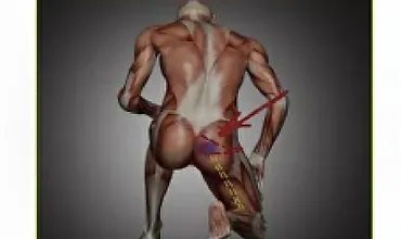 Изображение курса Красивые ягодицы. Импиджмент ТБС. Синдром грушевидной мышцы